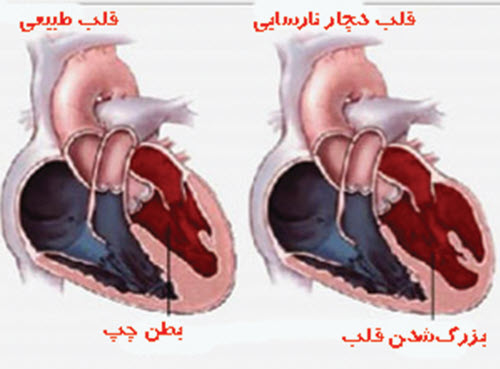نارسایی قلبی